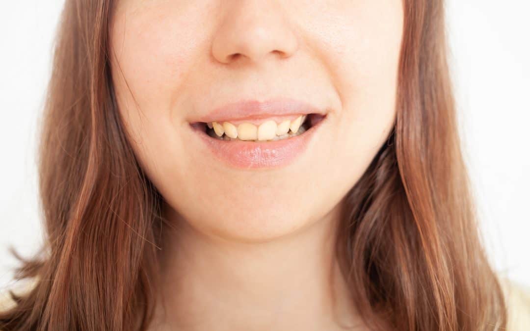 Malocclusion dentaire et acouphène : que faire ?