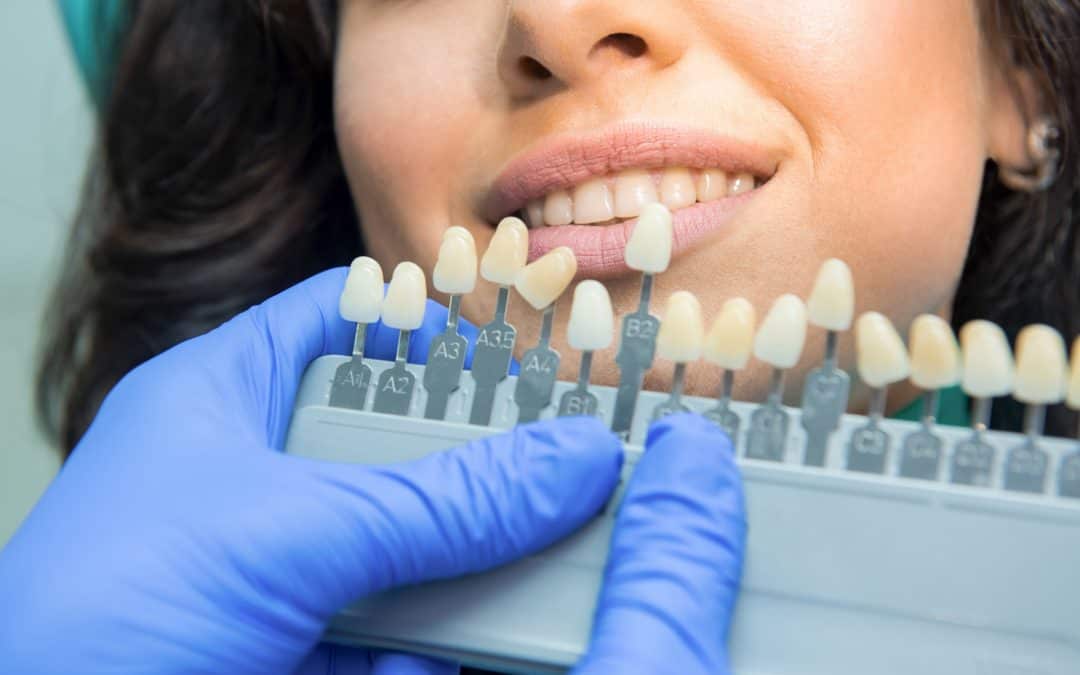 Sérums de blanchiment dentaire : pourquoi les éviter ?